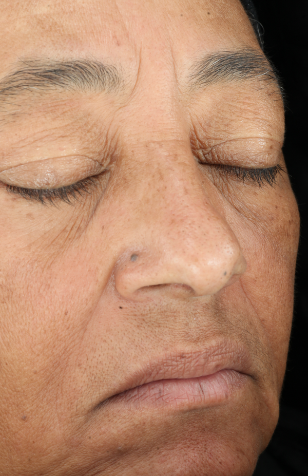 Before using SkinCeuticals C E Ferulic, showing visible wrinkles and uneven tone - Vos Collection