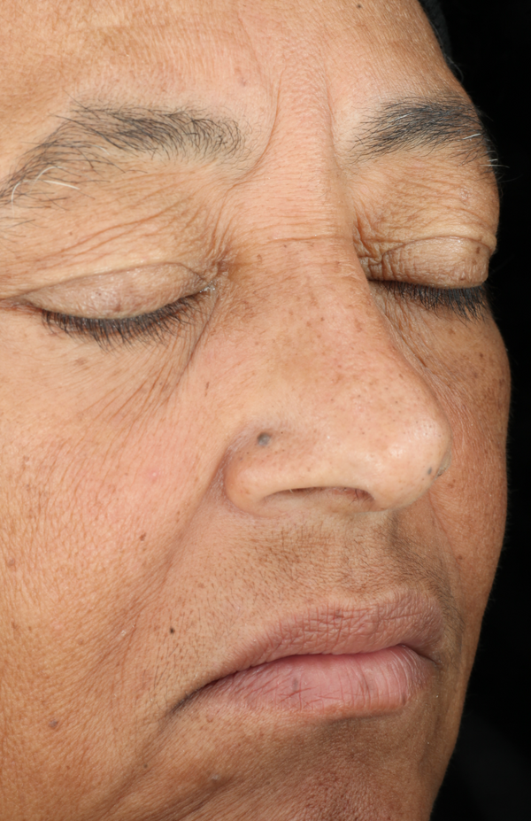 Before photo showing mature skin with wrinkles and sun spots - Vos Collection